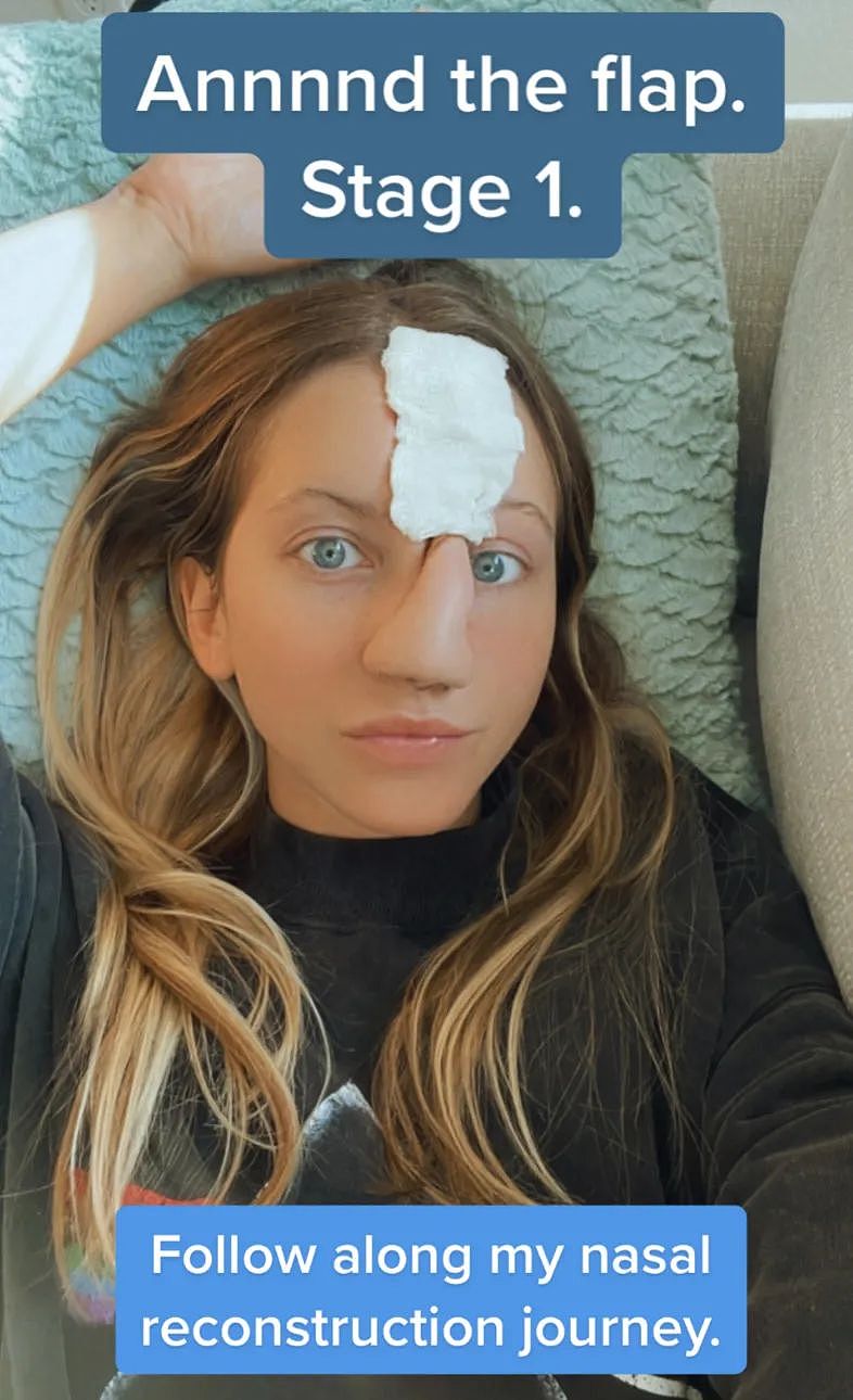 妹子被狗咬掉鼻梁，手术十几次用额头皮肤重建，过程触目惊心（组图） - 12