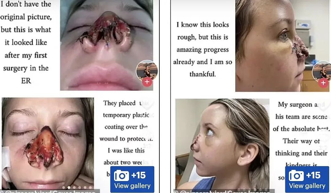妹子被狗咬掉鼻梁，手术十几次用额头皮肤重建，过程触目惊心（组图） - 5