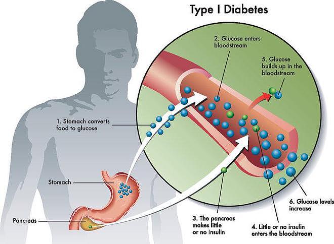 【健康】医学界发现：能活过80岁的糖尿病人，身上大多都有这5个特征（组图） - 2