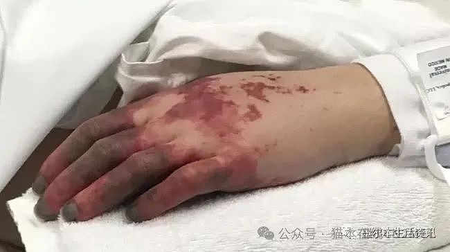 澳洲20岁女子出现胃痛和感冒症状后，在家中突然死亡！医生检查后才发现，她感染了致命细菌…（组图） - 18