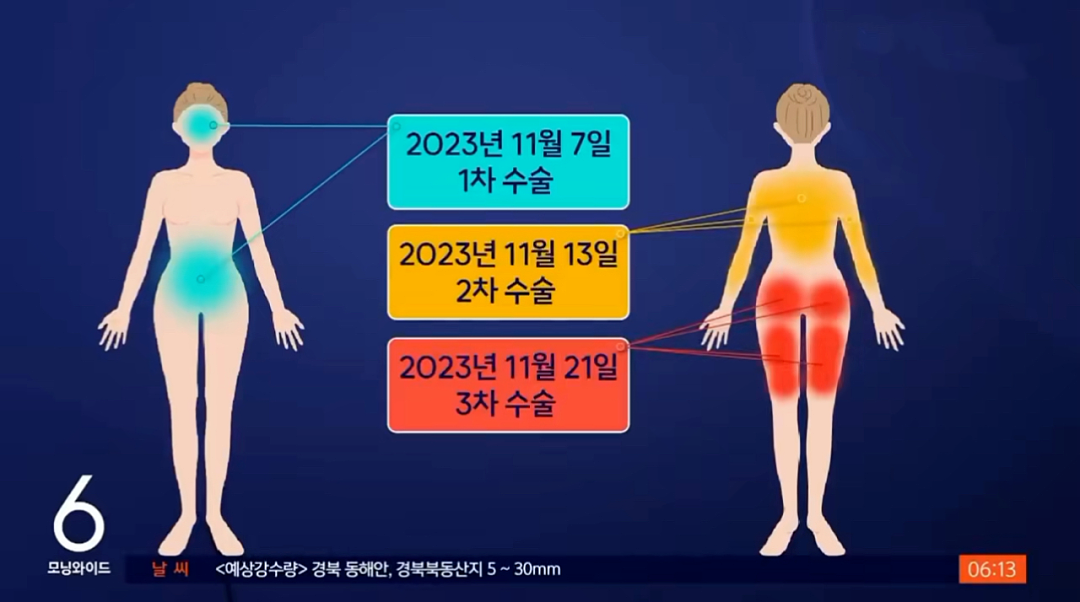 中国女孩死于抽脂：危险的“网红”韩国整容医院（组图） - 2