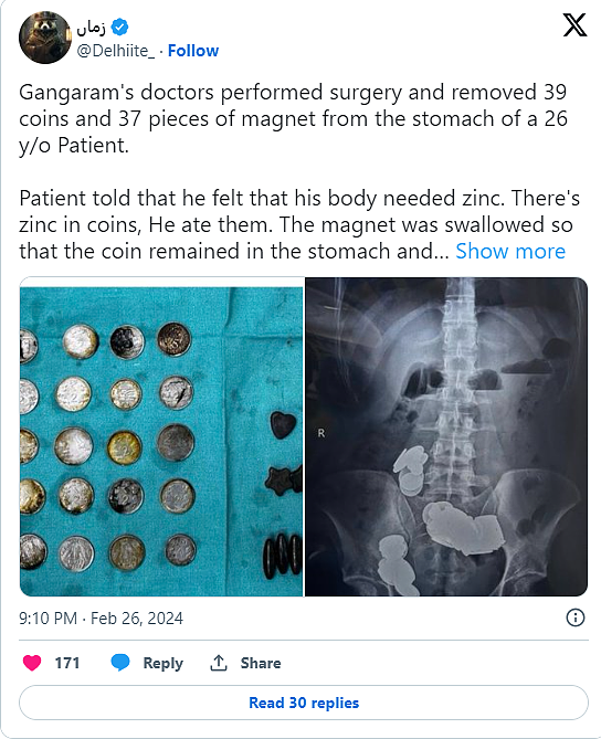误信健身偏方！印度男狂吞“76枚磁铁硬币”，剧烈腹痛20多天就医（组图） - 2