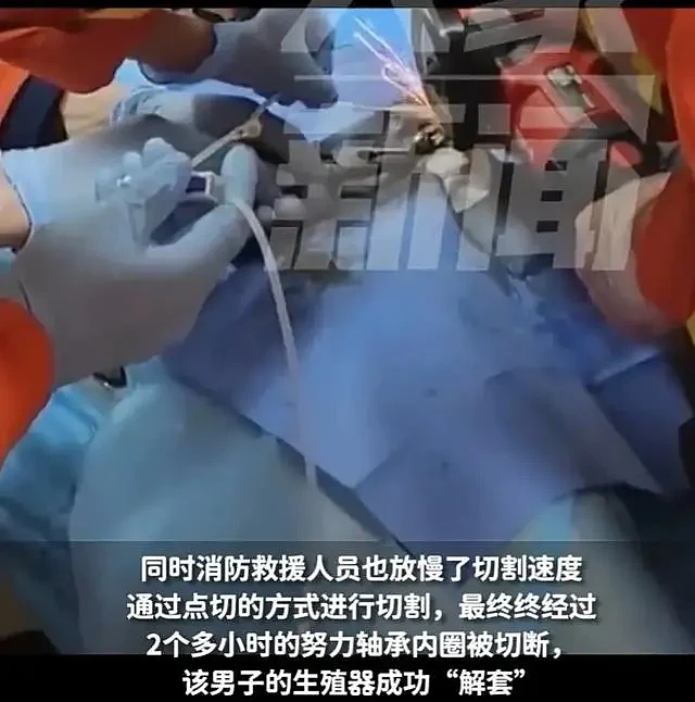 闹大了！温州一男子下体被轴承圈套住，严重肿胀，医生消防联手（组图） - 4