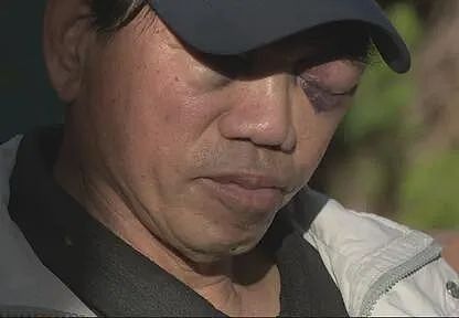 恐怖！73岁华人遭随机袭击打至重伤,骨折、脑震荡、满脸是血（组图） - 6