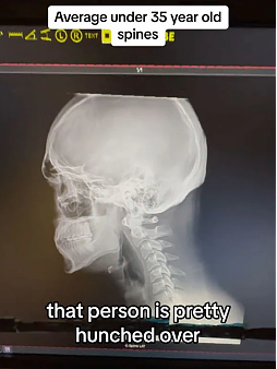 严重！脊医公开2个月的X光片，95后都成驼背老人，快做这件事（组图） - 3
