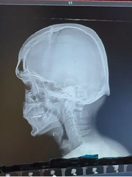 严重！脊医公开2个月的X光片，95后都成驼背老人，快做这件事（组图） - 7