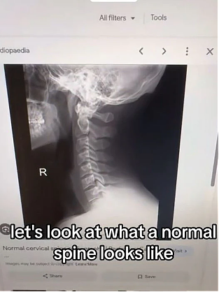 严重！脊医公开2个月的X光片，95后都成驼背老人，快做这件事（组图） - 2
