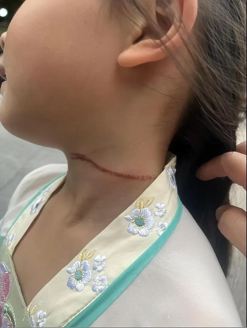 7岁女童遭风筝线割脖，家长：线很细，很难看见（组图） - 2