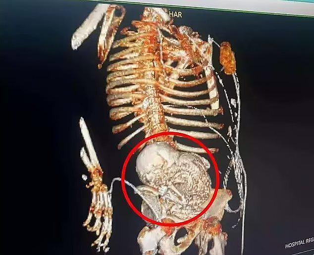 巴西81岁老妇的腹中取出了“石宝宝”，已怀了56年，手术后去世（组图） - 3