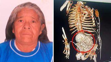 巴西81岁老妇的腹中取出了“石宝宝”，已怀了56年，手术后去世（组图） - 4