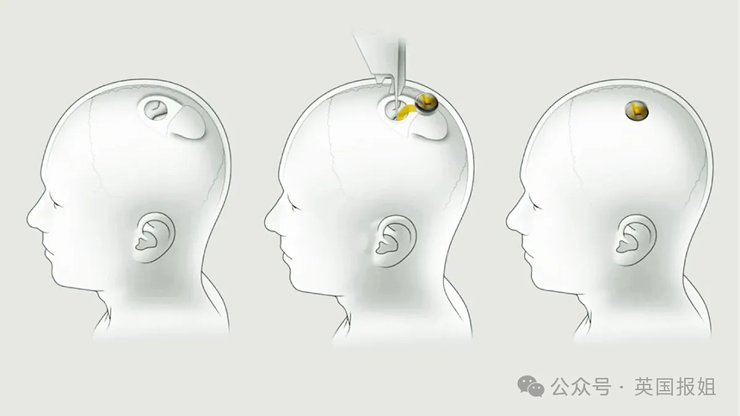 世界首例！马斯克公司成功将芯片植入人类大脑，意念控制时代已来临（组图） - 6