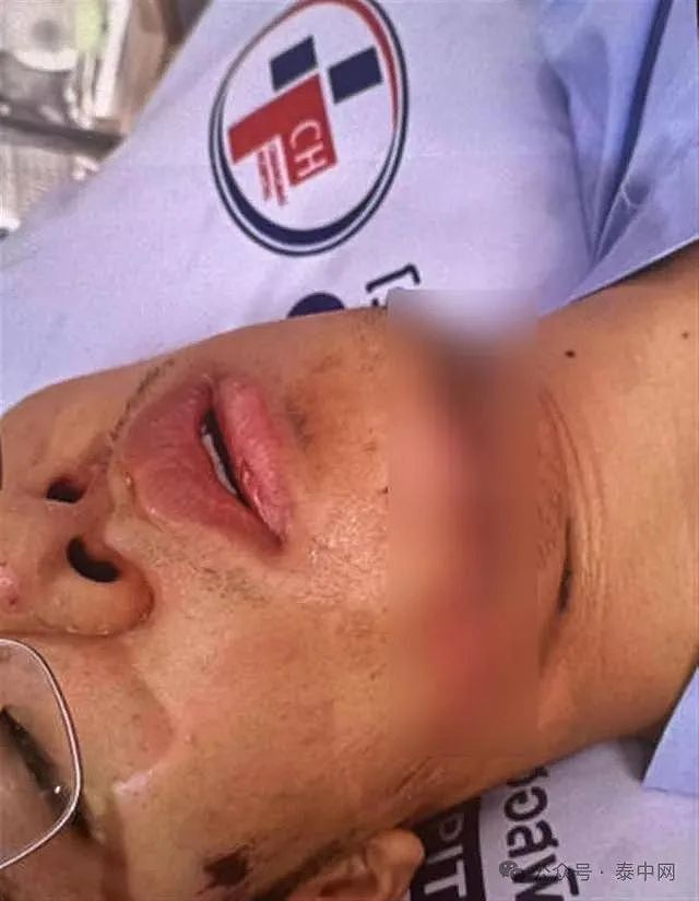 中国大学生泰国旅游被摩托车撞飞，下巴12cm伤口缝36针，车手只愿陪400（组图） - 3