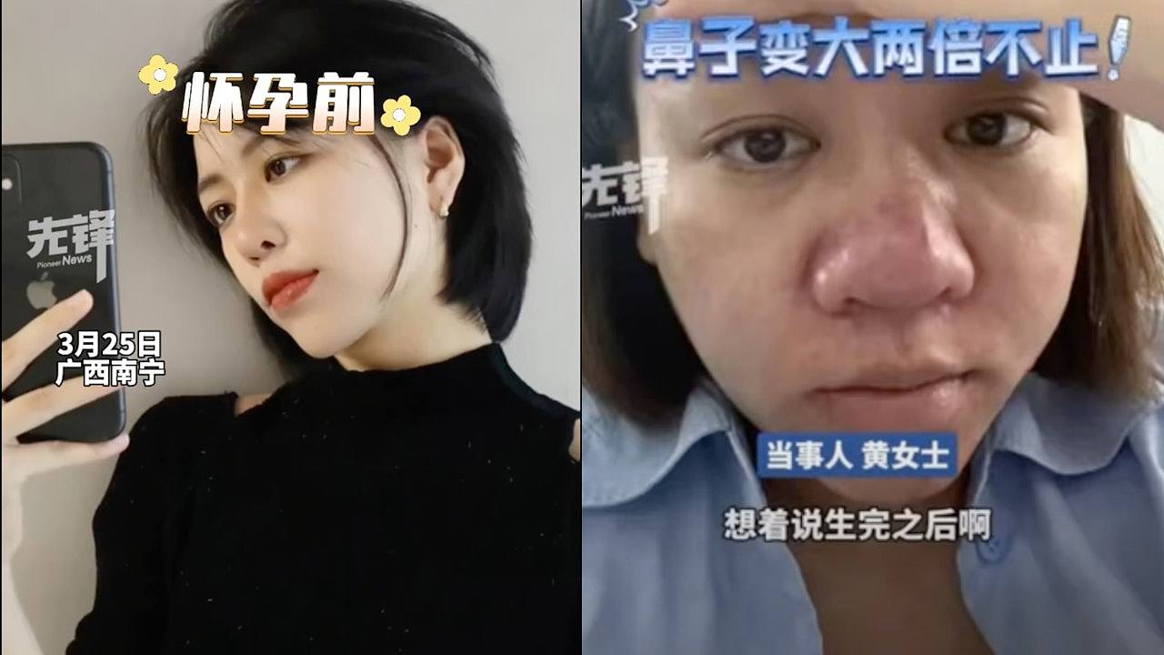 美女怀孕后鼻子大两倍、脸冒痘痘“判若两人”；网民：妈妈真伟大（视频/组图） - 1