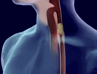 从口腔到肠胃，一口“烫食”伤害整个消化道（组图） - 2