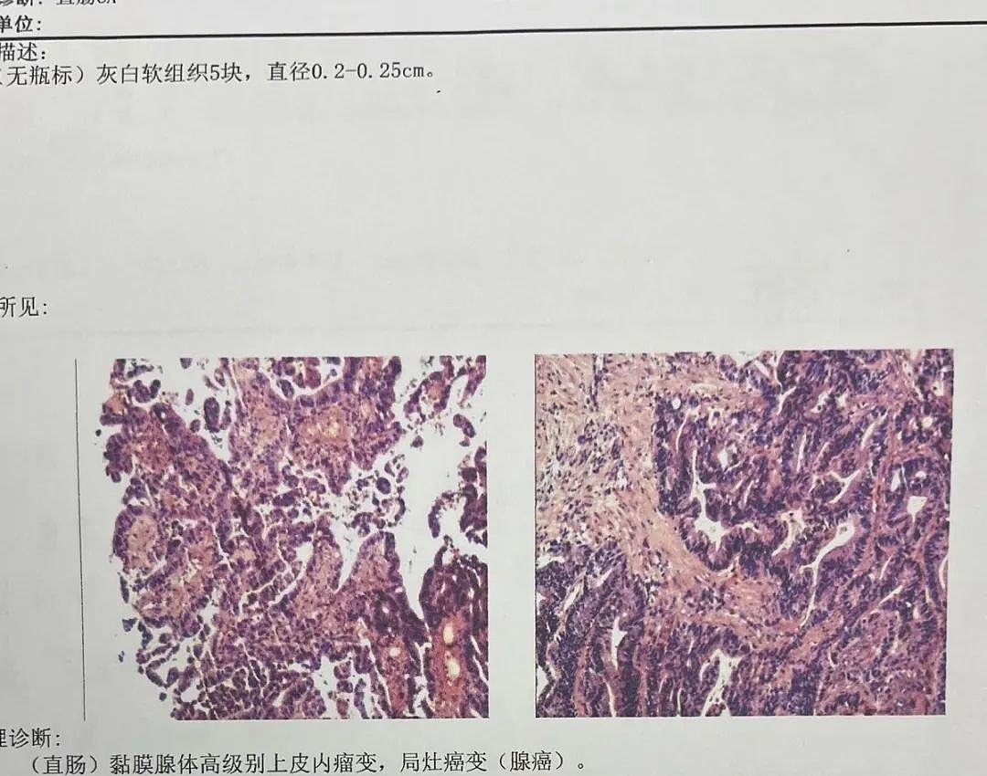 女子确诊癌症！家人震惊：她明明很养生！又是这个习惯害的...（组图） - 2