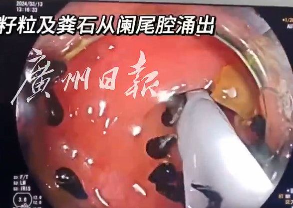 广州30岁男“吃西瓜不吐籽”引发阑尾炎！医生检查发现：卡十几颗籽（组图） - 3