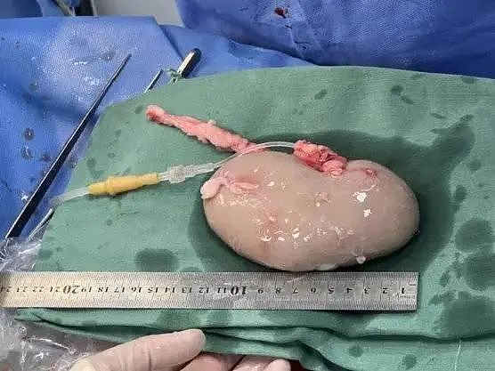 大突破！术前仅有几周生命，54岁女病人“猪肾和人工心脏联合移植手术”完成，其丈夫：重新看到了妻子的笑容（组图） - 7
