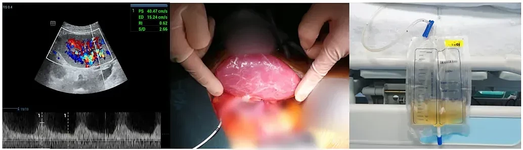 大突破！术前仅有几周生命，54岁女病人“猪肾和人工心脏联合移植手术”完成，其丈夫：重新看到了妻子的笑容（组图） - 5