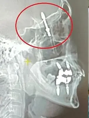 男子植牙发生惊悚意外！螺丝钉刺穿颌骨直接插入脑袋（图） - 1