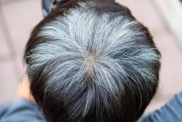 白发长在哪，病就从哪出？长在前额、两鬓、后脑勺，分别代表啥（组图） - 10