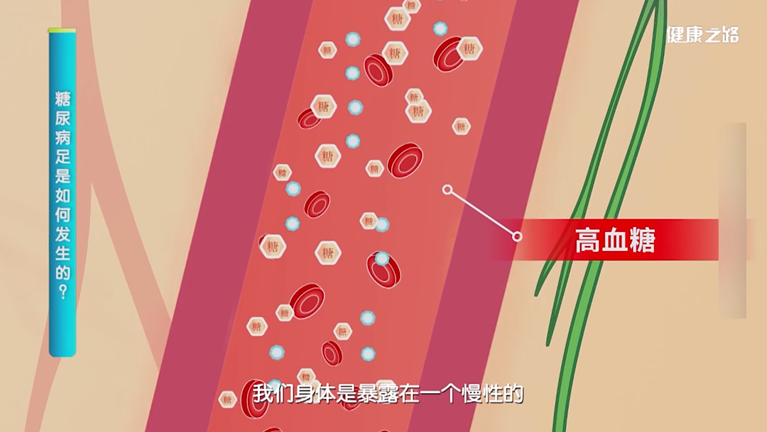 留意！双脚出现5个表现，多半是血糖超标了（组图） - 2