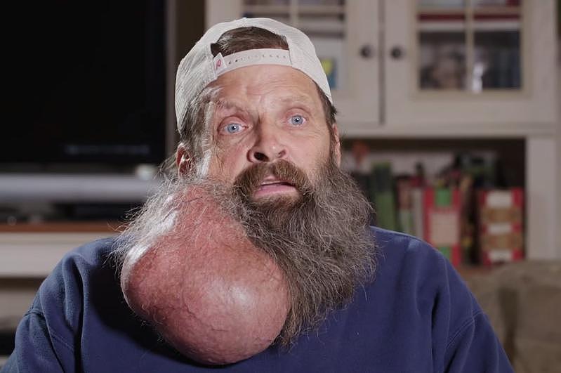 粉刺“养20年”变2.5公斤巨痘！亚州男割掉它变另一个人（视频/图） - 1