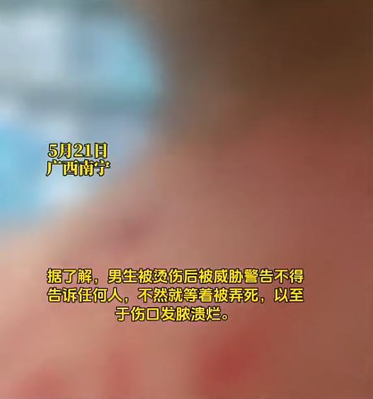 广西初中生遭同学淋11盆热水，9日后伤口流脓始揭发（组图） - 2