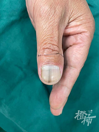 男子指甲上长出黑线，3年都没消失！去医院一查慌了：可能癌变吗？（组图） - 1