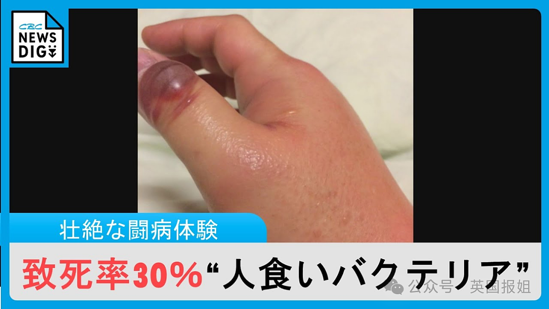 “夺命食人菌”攻占日本？致死率高达30%，半年感染人数大破记录！（组图） - 8