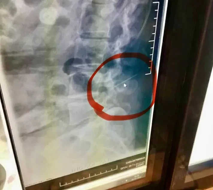 惊爆！ 加拿大妈妈生娃麻醉师忘了根针，插在脊柱上， 莫名痛了10年（组图） - 3