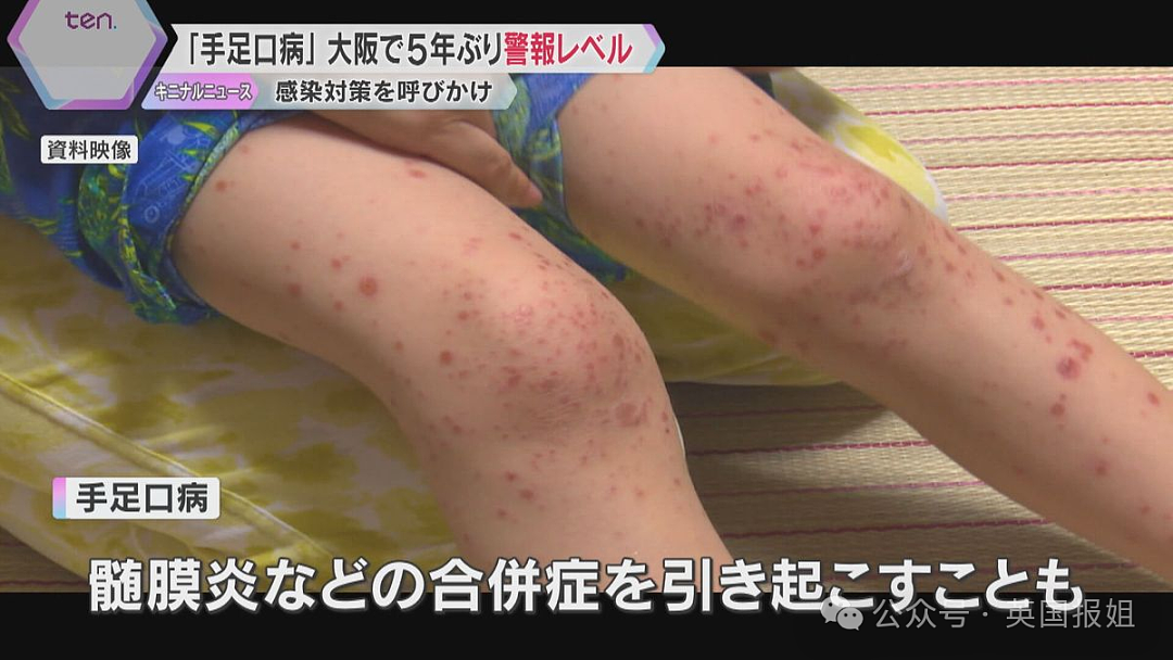 “夺命食人菌”攻占日本？致死率高达30%，半年感染人数大破记录！（组图） - 15