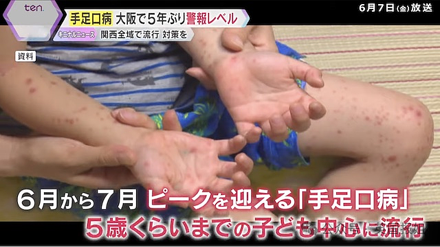 “夺命食人菌”攻占日本？致死率高达30%，半年感染人数大破记录！（组图） - 14