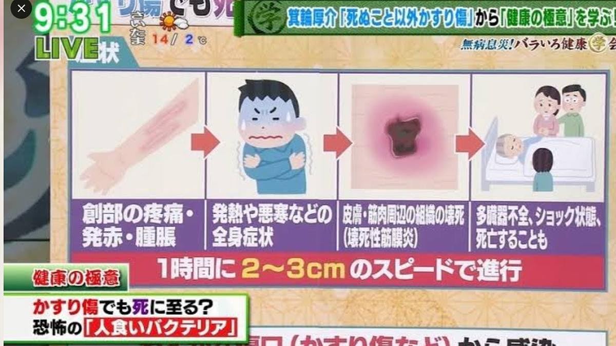 日本食人菌疫情大爆发，内地专家：或传染到国内　高危人士勿赴日（组图） - 4