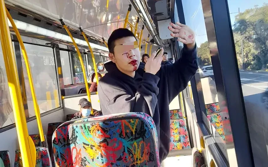 16岁中国留学生在公交车上无端遇袭！遭1米长铁棍暴打满脸血，断了5颗牙（组图） - 2