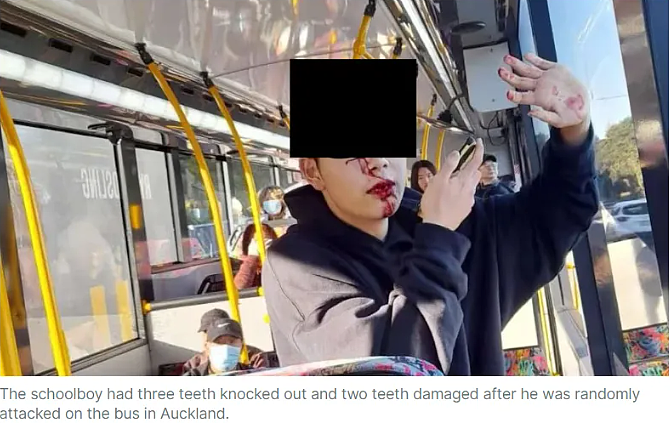 最新！被袭华人少年：公交司机没帮忙，奥克兰交通局无回应！父母哽咽：“他或永远失去6颗牙齿…”（组图） - 1