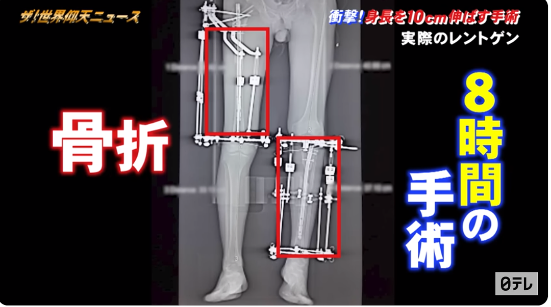 男子约会外国妹子被身高打击，远赴海外反复“断骨”只为增高10cm！（组图） - 38