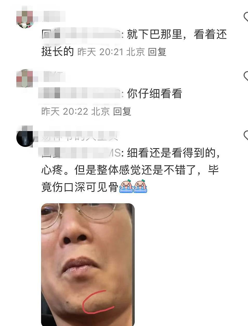 陈奕迅受伤一个月首露面，深见骨的下巴伤口变成长疤痕，恢复情况曝光（组图） - 9