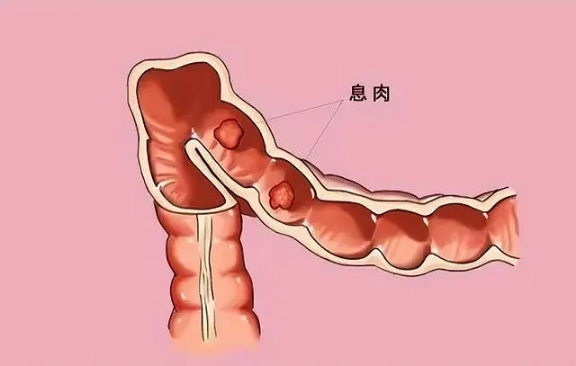 【健康】肠道里长了息肉，上厕所时会有3个提示，不要等到中晚期了才知道（组图） - 1