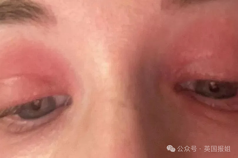 可怕！女子对月经过敏，每来一次全身都起严重红疹？“像100万只蚂蚁在我身上爬”（组图） - 8