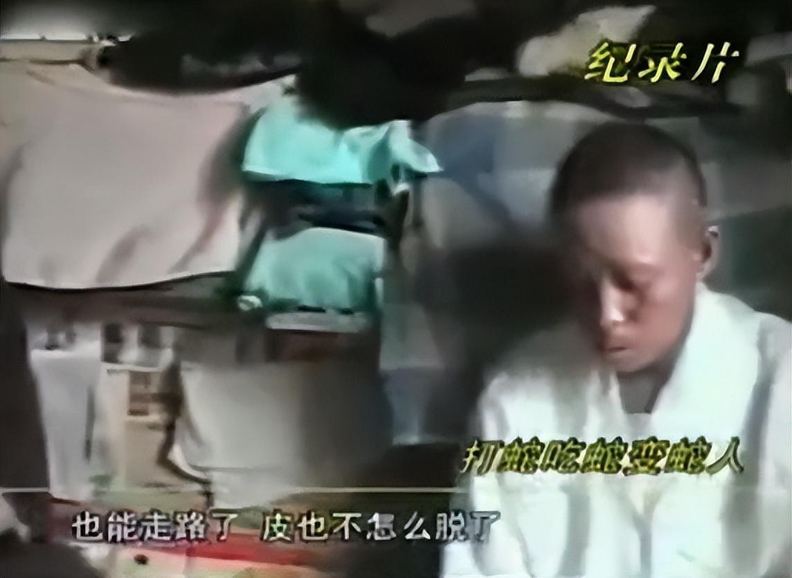 辽宁男子捕蛇吃蛇变“蛇人”，浑身脱皮长满鳞片，难道是诅咒（组图） - 14