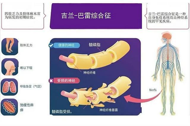 揪心！一顿烧烤后，广州大学生进ICU换了5次血，医生紧急提醒（组图） - 2