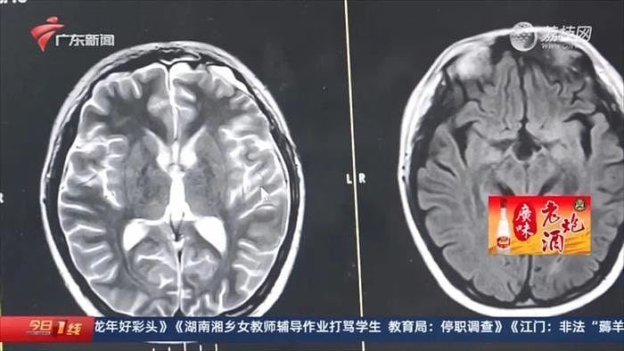 16岁仔常这样喝水，1年后惊揭患脑癌后续惨，医生警告4症状即求诊（组图） - 2