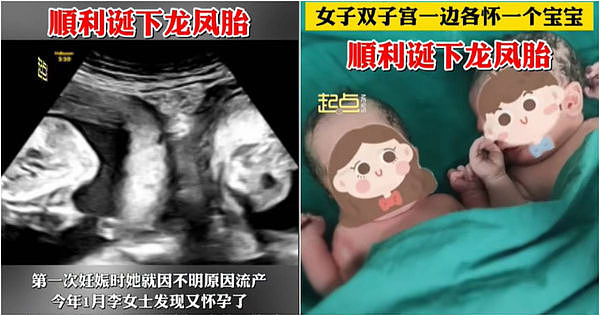 极罕见！陕西双子宫妇女左右各怀一胎，成功生下小兄妹（图） - 1