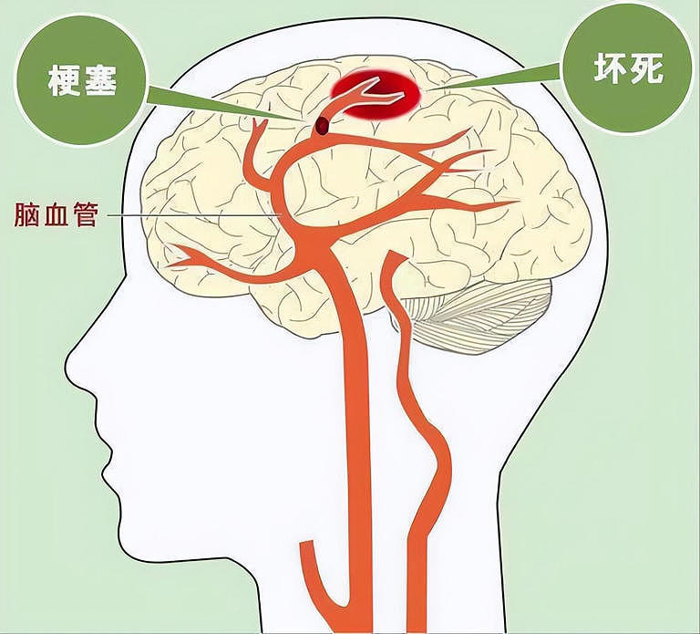 脑供血不足的6大信号，与这些疾病有关（组图） - 1