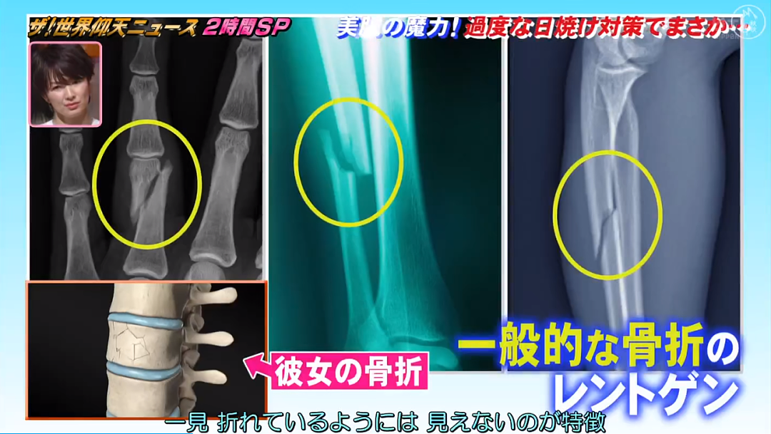 可怕!25岁漂亮小姐姐不想被晒黑，每天全副武装！2年后，身高竟缩水7cm（组图） - 22