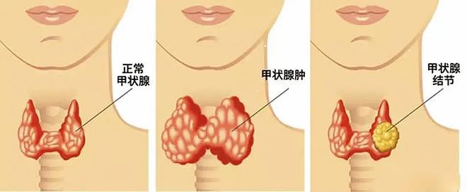 初代男神张根硕自曝患癌一年？全球增速最快的“懒”癌就在身边（组图） - 9