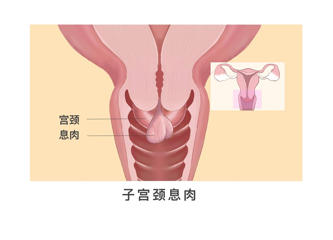 癌症来之前，都会经历“癌前病变”！这几类病，很多人没重视……（组图） - 3