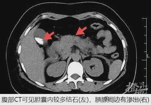 一口气干掉4只，25岁女子连夜抢救！专家提醒：餐桌上有这道菜的注意了（组图） - 1