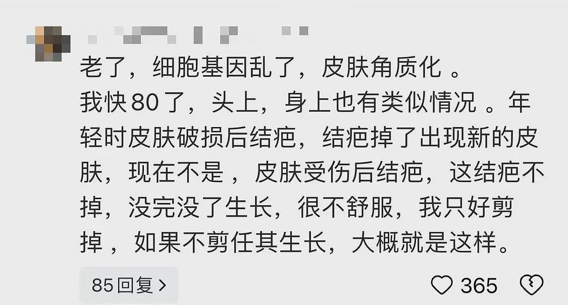 107岁老人额头长角被称“长寿角”，医生：是疾病表现，与年龄、日晒有关（组图） - 2