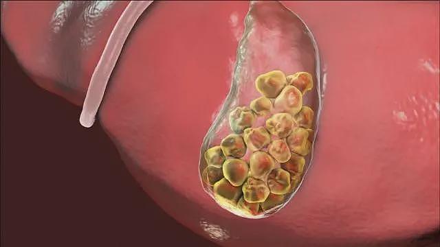 【健康】中国胆囊癌高发，罪魁祸首是什么？提醒：有2种饮食习惯，尽早改（组图） - 3
